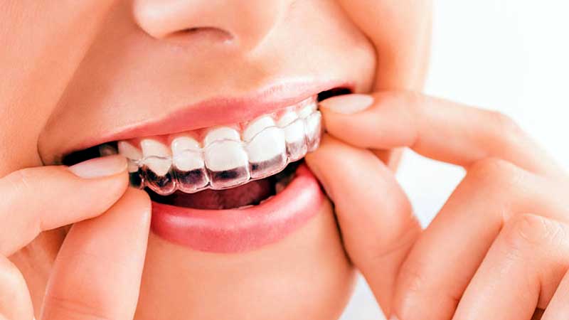 Clear Aligners