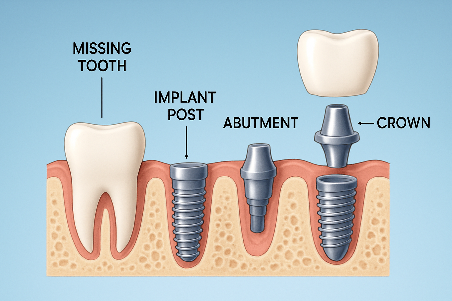 Dental Implant Parts - Post, Abutment and Crown