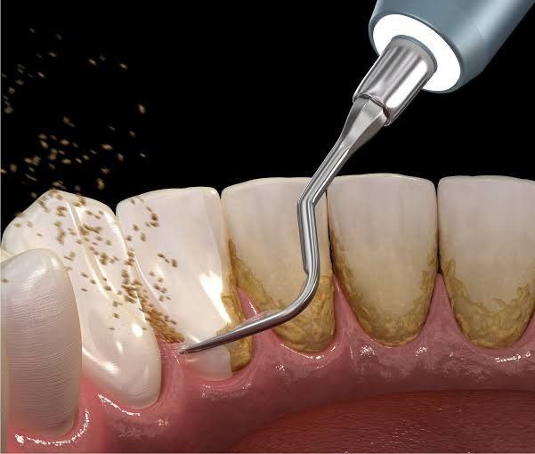 Teeth Cleaning