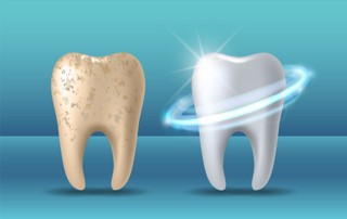 Teeth Whitening