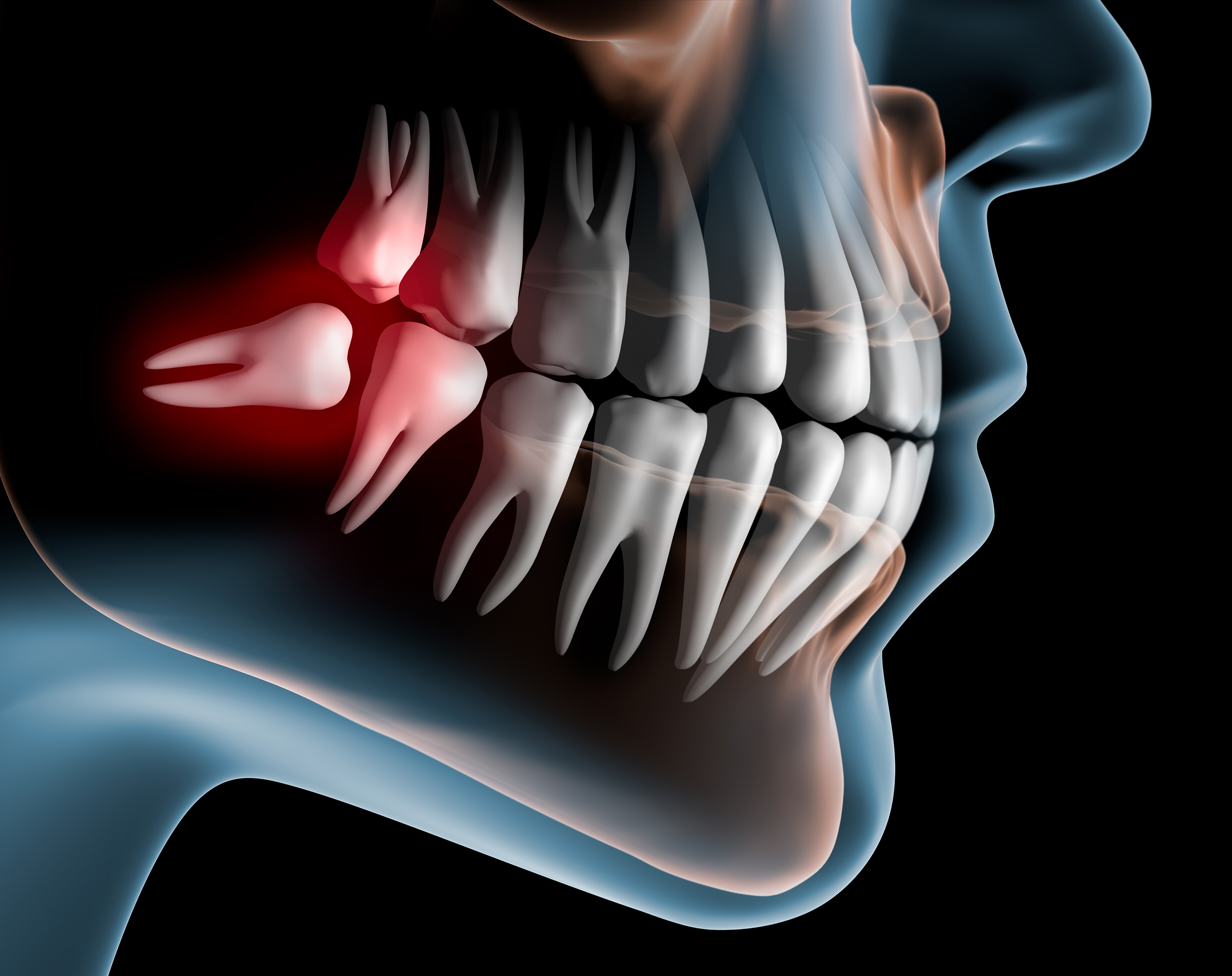 Wisdom Tooth Extraction