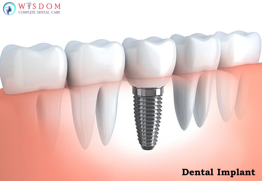 Implant