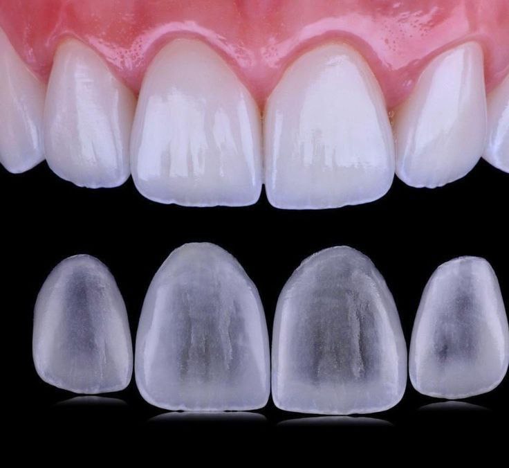 Veneers